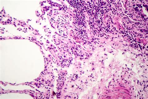 Dr John Cush On Twitter New Look At Fibrosis In Scleroderma Finds