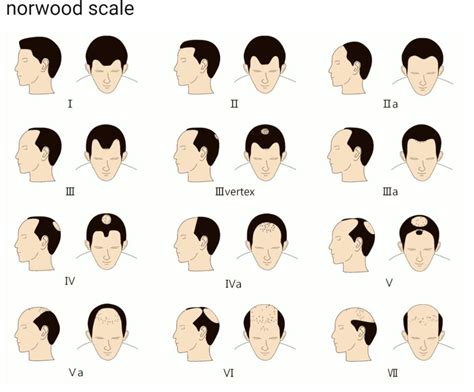 Update More Than 74 Types Of Hair Loss Male Super Hot In Eteachers