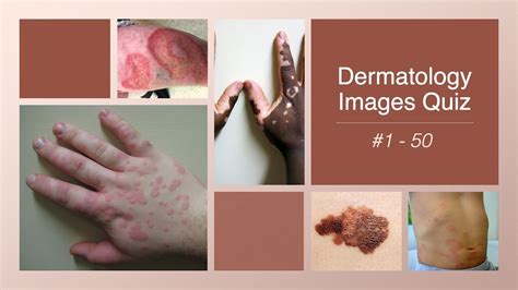 Dermatology Images Quiz 1 50 Youtube