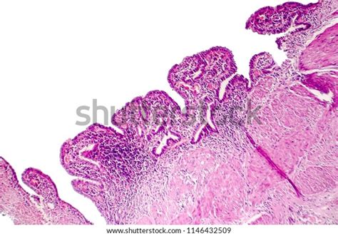 Chronic Cholecystitis Light Micrograph Photo Under Stock Photo