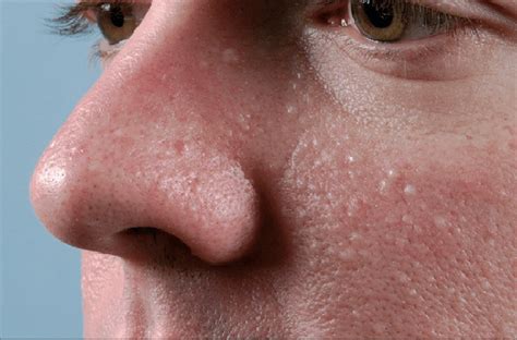 Multiple Dome Shaped Whitish Papules On The Nose And Cheeks In A