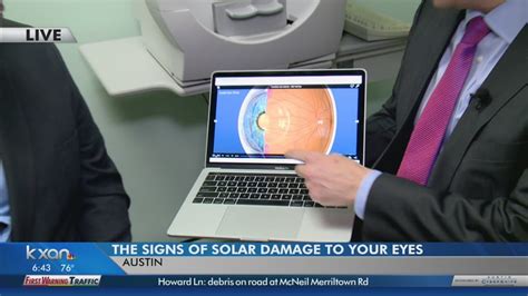Symptoms Of Eye Damage After Solar Eclipse 6am Youtube