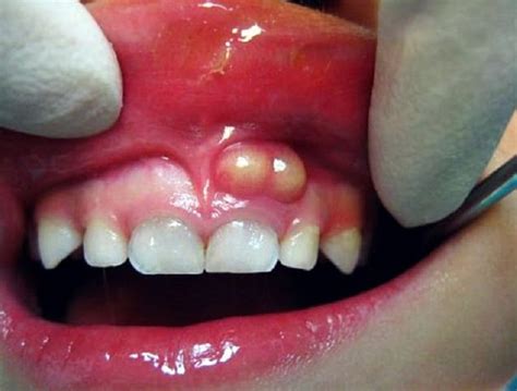 Comment Percer Un Abcès Dentaire Naturellement I Announce