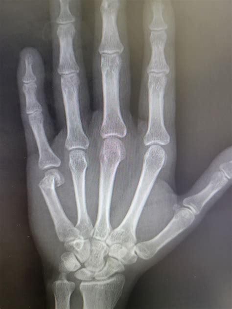 Th Metacarpal Boxer Fracture Doc Said I Don T Need Surgery But Do I