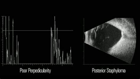 Uc3 Ultrasound Circular Cyclo Coagulation A New Method For Treating