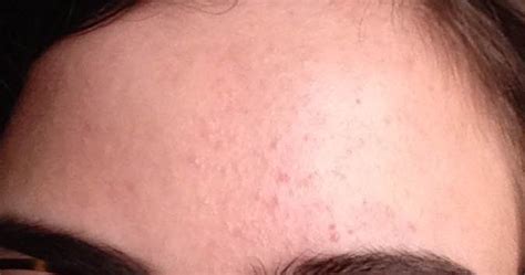 Small Bumps On My Forehead General Acne Discussion Community