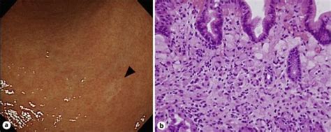 Endoscopic And Histological Finding Of The Signet Ring Cell Gastric