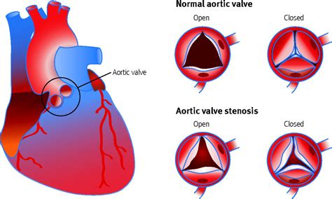 Aortic Stenosis Overview Signs And Symptoms Pathophys