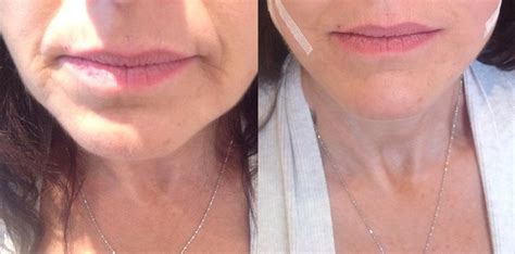 Before And After 4 Point Lift Using Pdo Threads Thread Lift Thread