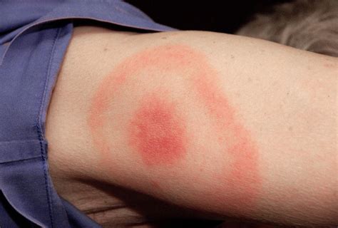 Pa Department Of Health On Twitter Not All Lyme Disease Rashes Have A