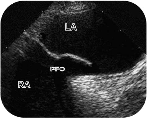 The Significance Of Patent Foramen Ovale International Journal Of