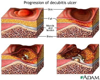 Progression Of A Decubitis Ulcer MedlinePlus Medical Encyclopedia Image