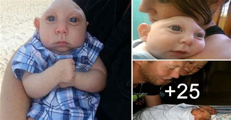 A Baby Born Without Part Of Its Brain And Skull Defies Science