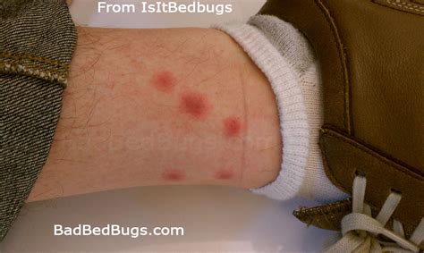 Bed Bug Bite Discussion 1