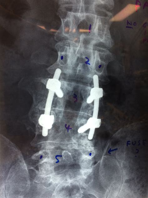Lumbar Fusion For Back Pain Front Range Spine And Neurosurgery