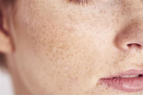 What Are Freckles Healthylooks Medspa Kansas City Medspa