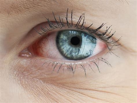 Dry Itchy Eyes Could Mean More Than Just Allergy