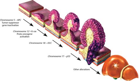 19 Benign Neoplasms Of The Colon And Rectum Abdominal Key