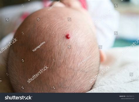 Strawberry Hemangiomas Red Birthmark On Babys Stock Photo 1352735111