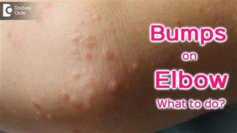 Eczema Bumps On Elbows