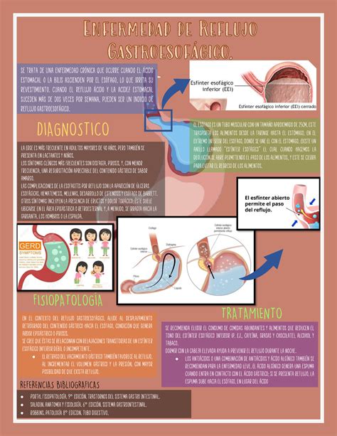 Infografía De Enfermedad De Reflujo Gastroesofágico Erge Se Trata