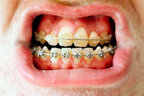 This set is often saved in the same folder as. Eat Food With New or Tightened Braces | Dental, Braces and ...