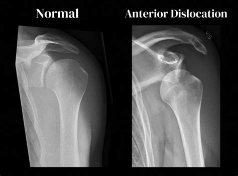 Anterior Shoulder Dislocation