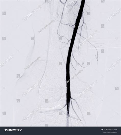 Femoral Angiogram Medical Procedure Used Visualize Stock Photo