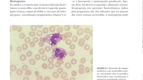 Granulação Toxica Nos Neutrofilos