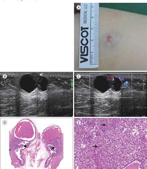 Figure 1 From Ultrasonography Of Malignant Clear Cell Hidradenoma A