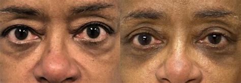 How Much Does A Blepharoplasty Cost Dr Anthony Farole Dmd Facial
