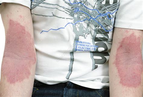 Eczema On The Arm Stock Image C0106666 Science Photo Library