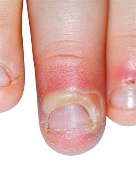 An Unusual Finger Injury The Bmj