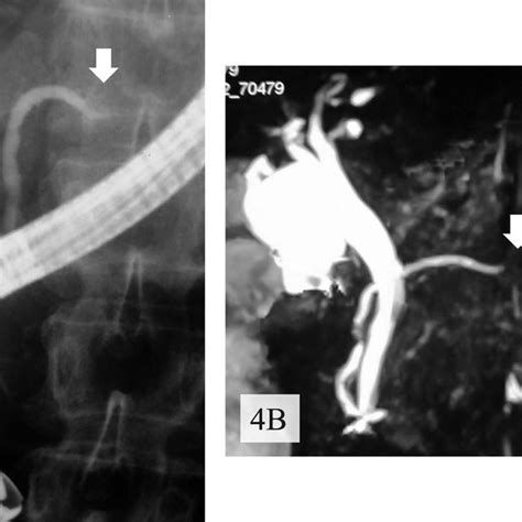 Ercp A And Magnetic Resonance Cholangiopancreatography B Showed