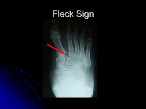 Lisfranc Injury Fleck Sign