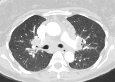 049lu Tb Scrofula Lymphadenitis Pericarditis Lungs