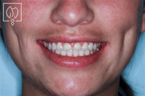 Severely Worn Dentition Case 1812 Elite Prosthetic Dentistry