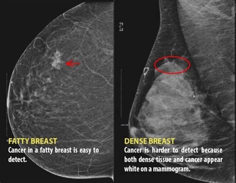 Dense Breast Awareness Has Skyrocketed In The Past Year Says Advocate