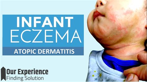 How To Treat Infant Atopic Dermatitis Eczema We Found The Best