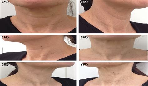 Treatment Of Horizontal Wrinkles Of The Neck Using A Hyaluro
