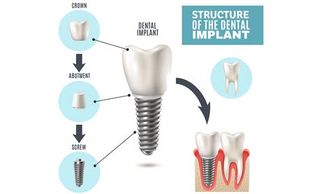 3 Options For Replacing Missing Teeth Dental Implants Dental Implants