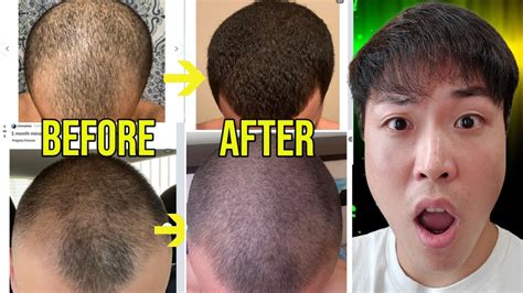 Bald People Reverse Hair Loss After Adding Microneedling Incredible