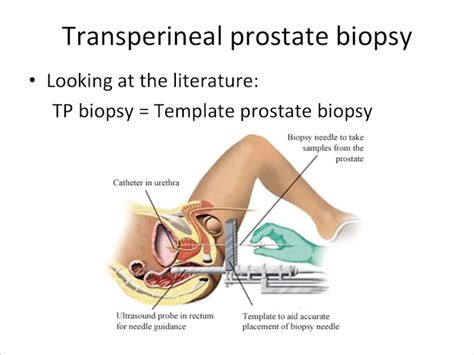 Roberto Miano Md Transperineal Prostate Biopsy State Of The Art