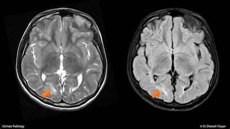 Ultimate Radiology Parieto Occipital Encephalomalacia In A Child