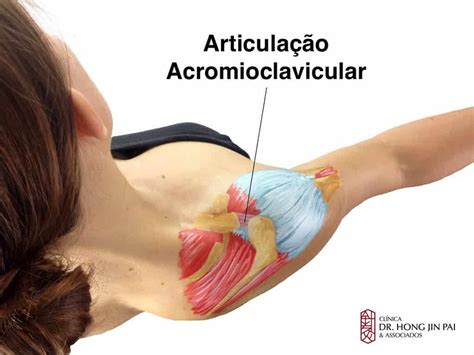 Artrose Acromioclavicular Ombro