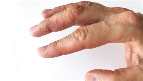 How To Care For Dry Hands After Washing Them Too Much Hand Sanitizer