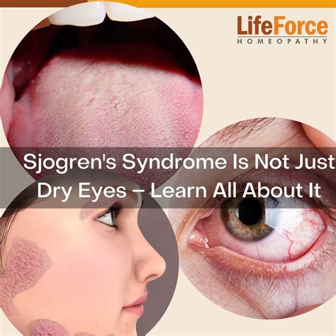 Sjogrens Syndrome Is Not Just Dry Eyes Learn All About It