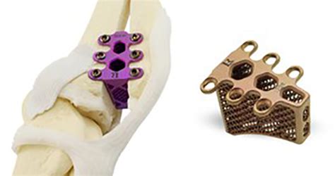 3d Printed Knee Implants Todays Medical Developments
