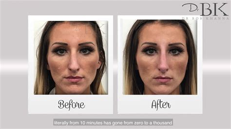 Heidi Nose Transformation Drbk Clinic Youtube