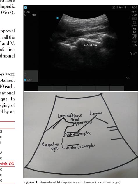 Figure 1 From A Cohort Study Of Anatomical Landmark Guided Midline